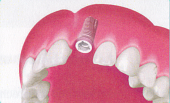 Eingeheiltes Implantat