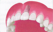 Mit Zahnkrone versorgtes Implantat