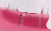 Eingeheiltes Implantat