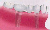 Mit Zahnkrone versorgtes Implantat