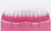 Implantat-getragene herausnehmbare Prothese