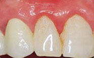 Entzündetes Zahnfleisch (Gingivitis)